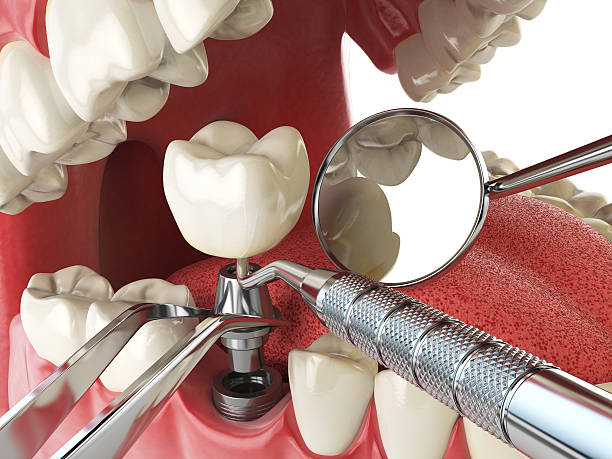 Best Emergency Dental Extractions in Shorewood Forest, IN